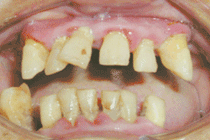歯周病患者